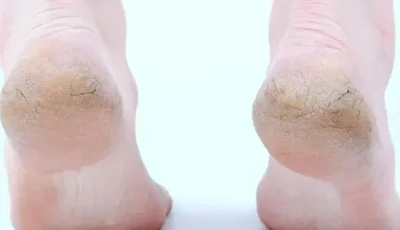 تشقق الكعبين: الأسباب، العلامات، ووسائل الوقاية