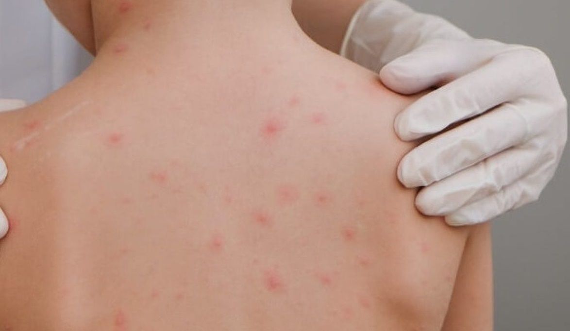 الجديري المائي سريع العدوى.. والتطعيم الوسيلة ا…