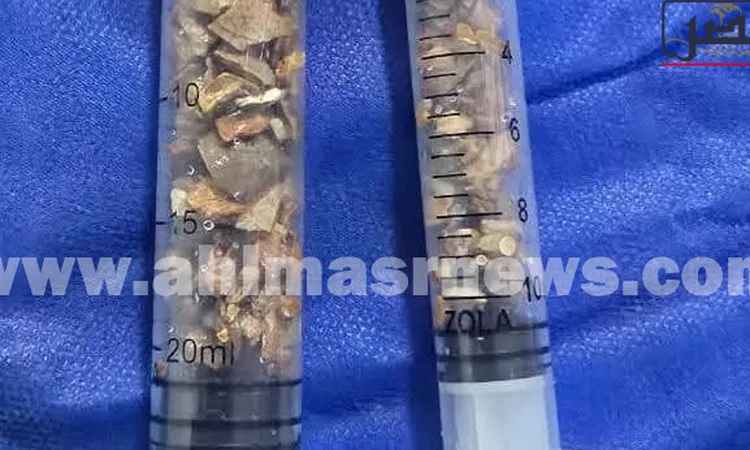 استخراج حصاة بطول 7 سم من كلى مريض بمستشفى دسوق العام | صور