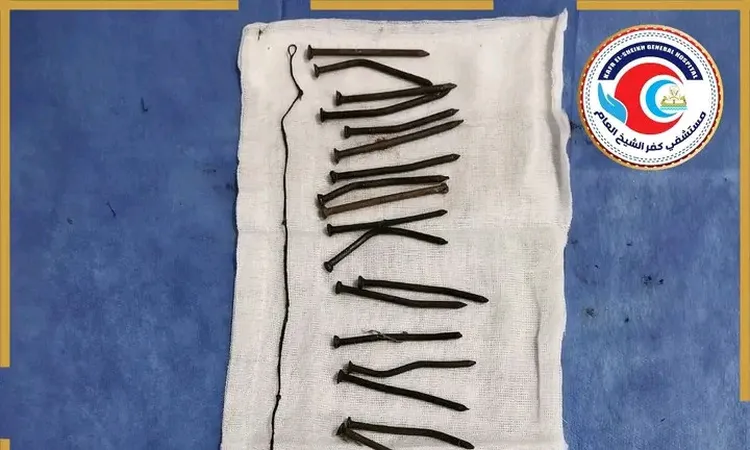 أطباء مستشفى كفر الشيخ العام يستخرجون 34 مسمارًا حديديًا من معدة مريضة | صور