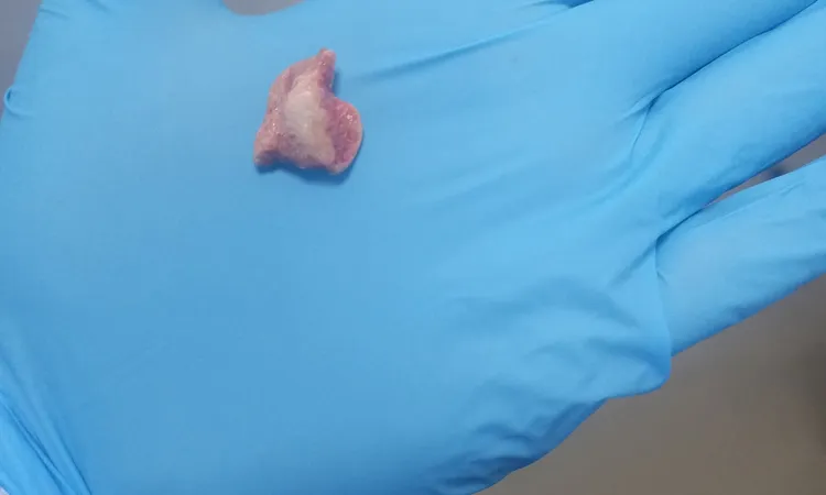 استخراج «زلطة» من المريء لطفل رضيع بمستشفى جامعة بني سويف