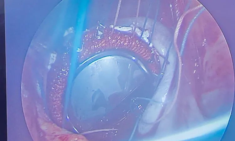 مستشفى كفر الشيخ الجامعي يُجري أول عملية لتغيير الصمام المترالي بالمنظار | صور